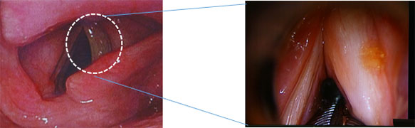 右反回神経麻痺による嗄声に、声帯内脂肪注入術を行った内視鏡写真
