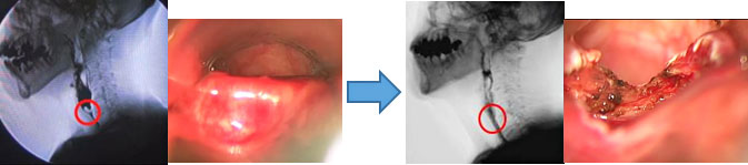 嚥下機能低下に対して、内視鏡下輪状咽頭筋切除術による嚥下機能の回復