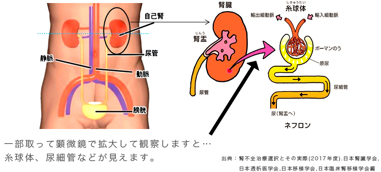 腎臓 が 悪く なると