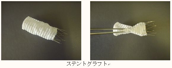 ステントグラフト