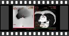 OPCAB㑢e-3DCT-2