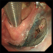 下咽頭表在がんに対する内視鏡下咽喉頭手術（ELPS）での切除例