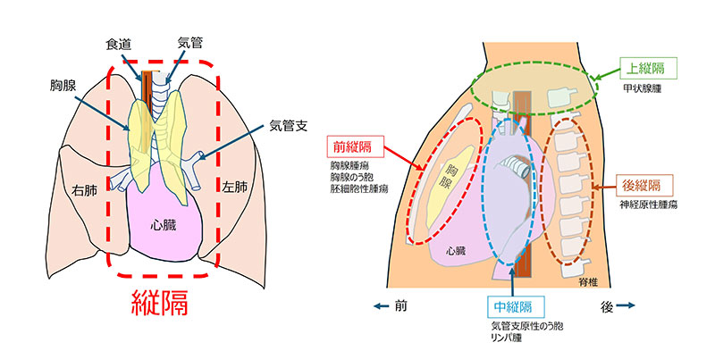 縦隔腫瘍図1