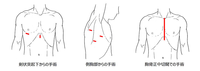縦隔腫瘍図２