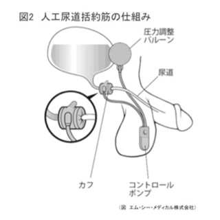 図2 人工尿道括約筋の仕組み
